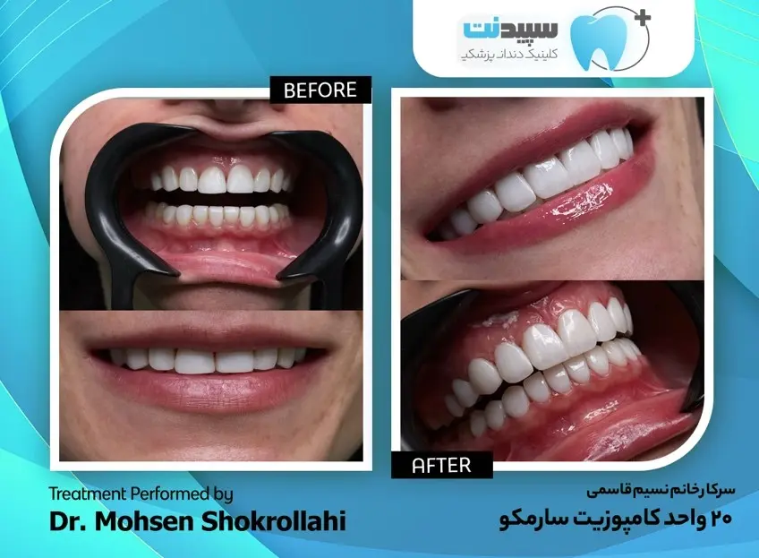 کامپوزیت دندان