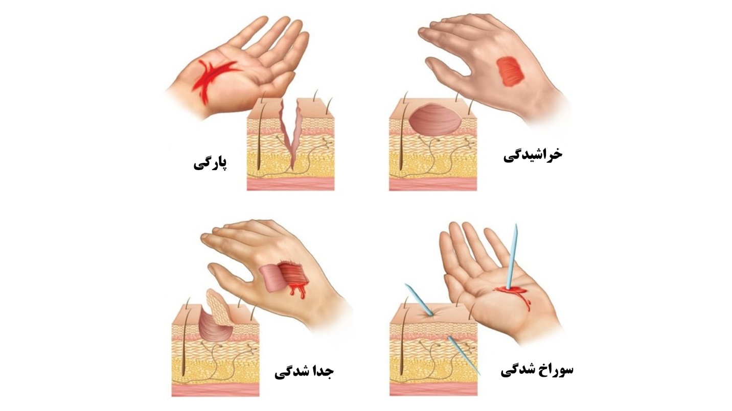 انواع زخم چیست - تصویر 2