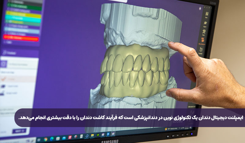 ایمپلنت دیجیتال - تصویر 2