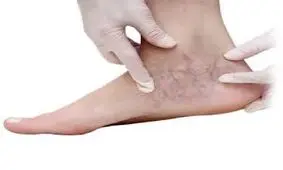 واریس در خانم ها بیشتر است