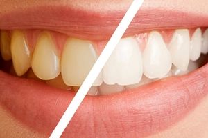جرم گیری هیچ تاثیر منفی بر مینا و ریشه دندان ها ندارد