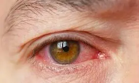 چه غذاهایی فشار چشم را بالا می‌برد؟

