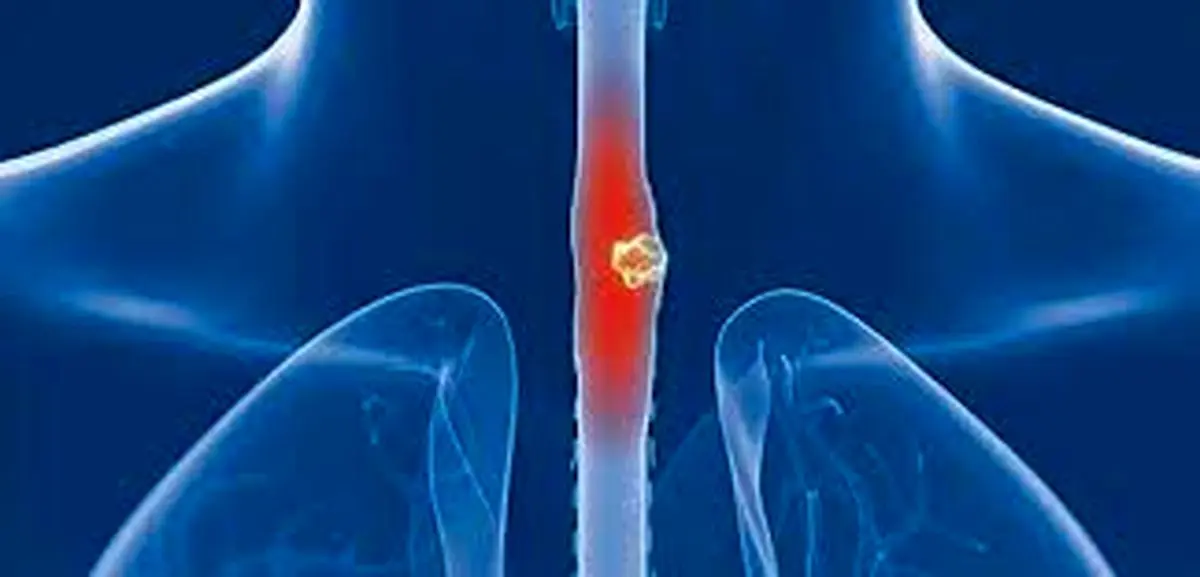 علائم پنهان سرطان مری