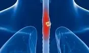 علائم پنهان سرطان مری