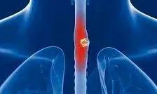 علائم پنهان سرطان مری