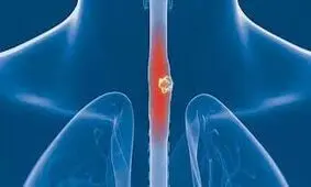 علائم پنهان سرطان مری
