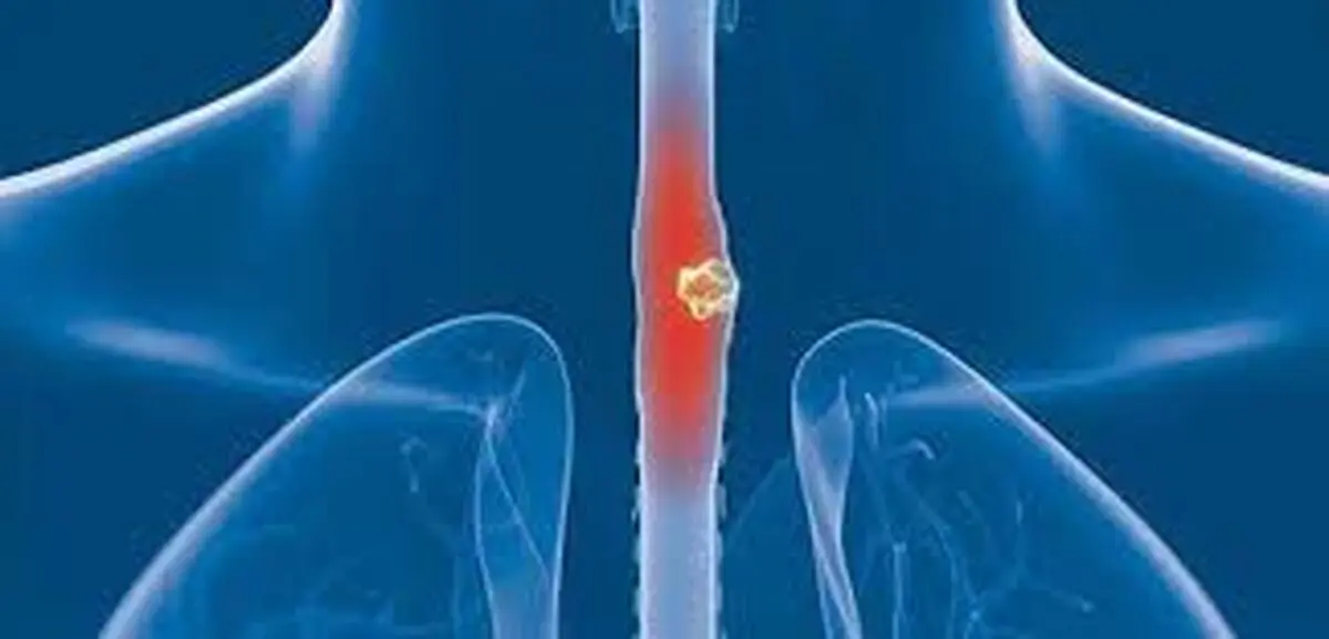 علائم پنهان سرطان مری