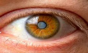 از کجا بفهمیم آب مروارید داریم؟