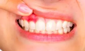 بیماری های لثه شاید مقدمه ای برای ابتلا به دیابت نوع ۲ باشند