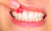 بیماری های لثه شاید مقدمه ای برای ابتلا به دیابت نوع ۲ باشند