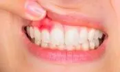 بیماری های لثه شاید مقدمه ای برای ابتلا به دیابت نوع ۲ باشند