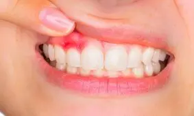 بیماری های لثه شاید مقدمه ای برای ابتلا به دیابت نوع ۲ باشند