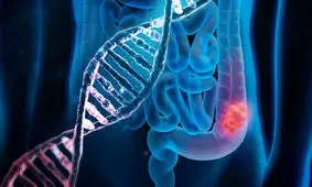 سرطان روده به زیر ۴۰ سال رسید/ ۶۰ درصد ایرانی ها اضافه وزن دارند