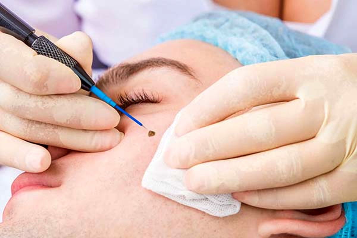 آیا برداشتن خال خطرناک است؟