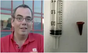 جراحی باورنکردنی: ۴۰ سال یک اسباب‌بازی در ریه!