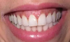 لثه ناسالم موجب تشدید بیماری مزمن ریوی می شود