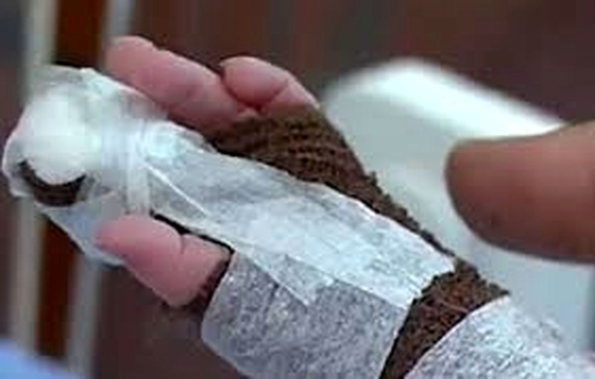 قطع انگشت نوزاد ۹/۵ ماههی زنجانی با قیچی