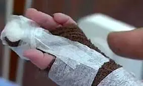 قطع انگشت نوزاد ۹/۵ ماهه‌ی زنجانی با قیچی