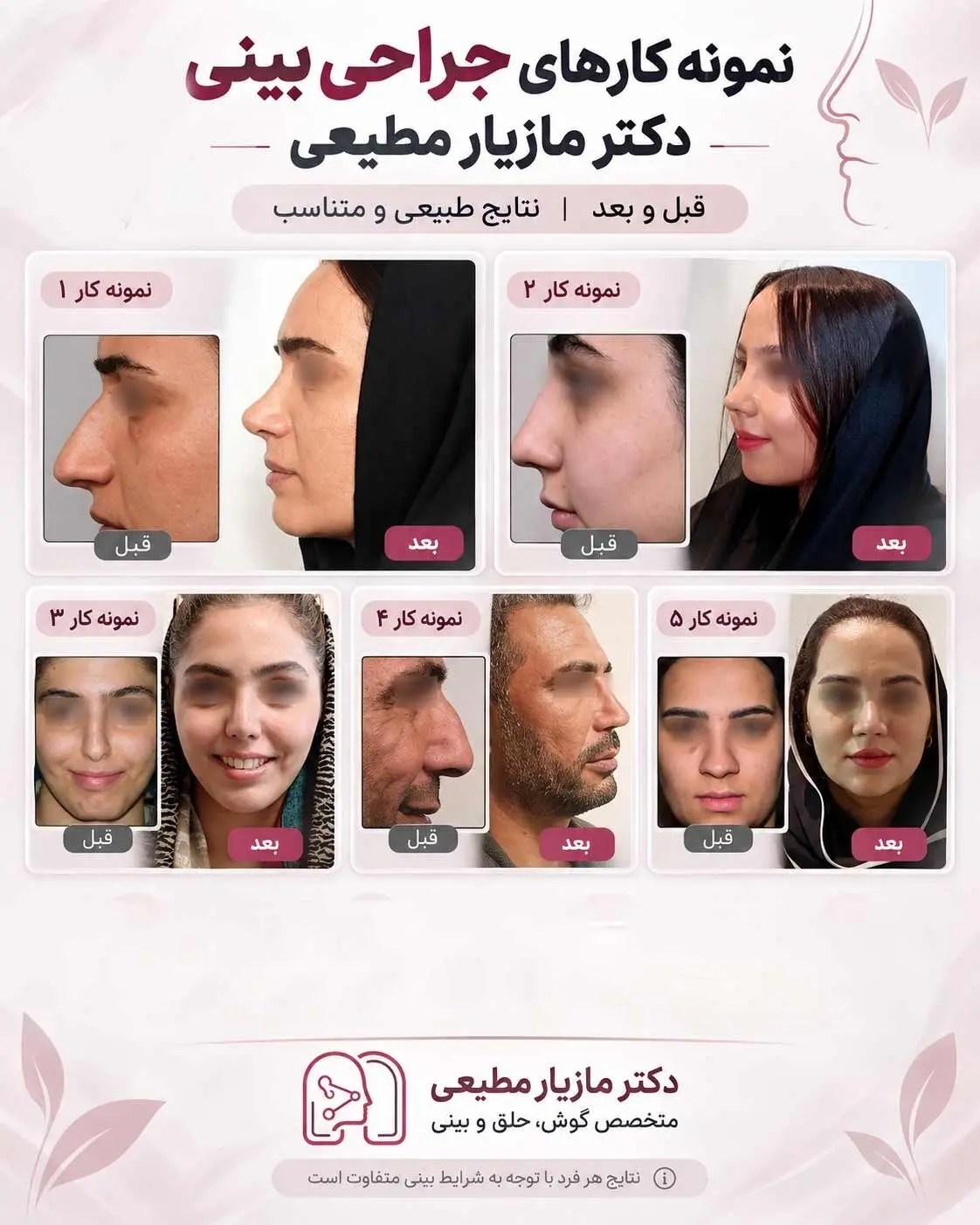 نمونه کارهای جراحی بینی دکتر مازیار مطیعی