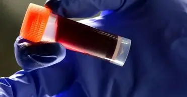 گروه خونی که بیشتر از همه سکته مغزی می‌کند!