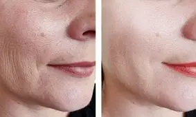 با تزریق پروفایلو چند سال جوان‌تر شوید