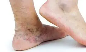 روشی جدید برای درمان واریس