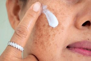 هرگونه تغییر در خال پوستی خود را جدی بگیرید