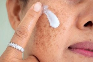 هرگونه تغییر در خال پوستی خود را جدی بگیرید