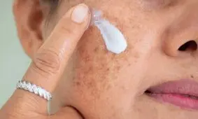 هرگونه تغییر در خال پوستی خود را جدی بگیرید