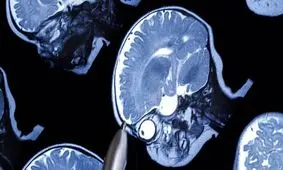 امکان تشخیص اوتیسم در کودکان ۲ ساله با استفاده از هوش مصنوعی

