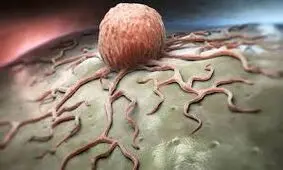 علائم سرطان پستان در مردان