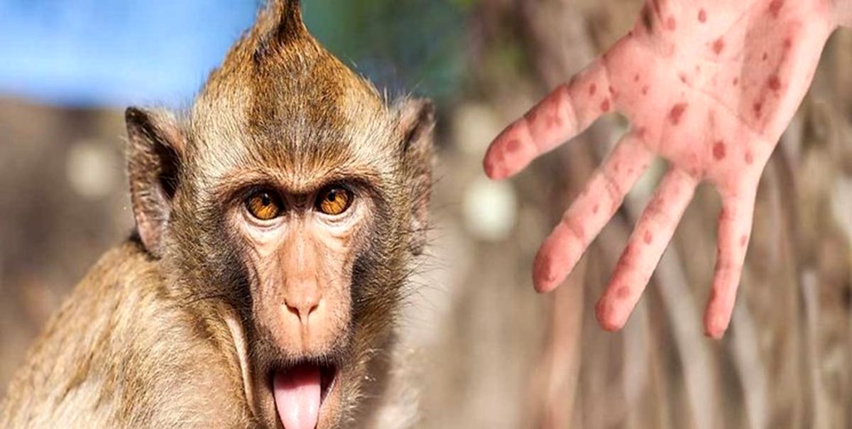 افزایش شمار مبتلایان به آبله میمون در جهان به بیش از 13 هزار نفر/ علایم آبله میمون