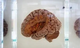 سرنخ‌ جدیدی درباره یکی از شدیدترین پیامدهای سکته مغزی

