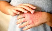 علت تشدید اگزما در نتیجه استرس کشف شد