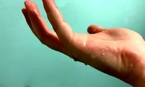 ماجرای یک پودر مرموز؛ درمان یا تهدید پنهان بیماران هایپرهیدروزیس؟