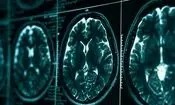 روشی در توقف بیماری آلزایمر کشف شد