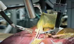 رباتی که بدون کمک انسان، جراحی کیسه صفرا را انجام داد

