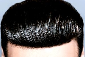 درصد موفقیت کاشت مو به چه عواملی بستگی دارد ؟