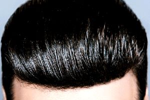 درصد موفقیت کاشت مو به چه عواملی بستگی دارد ؟