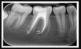 نانو ربات هایی که ریشه دندان را درمان می‌کنند