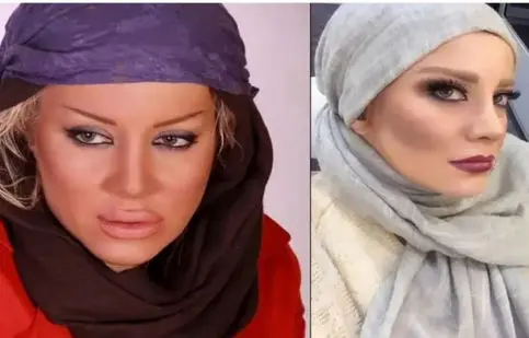 شراره رخام: تزریق ژل لب بازیگری منو نابود کرد/ ویدئو