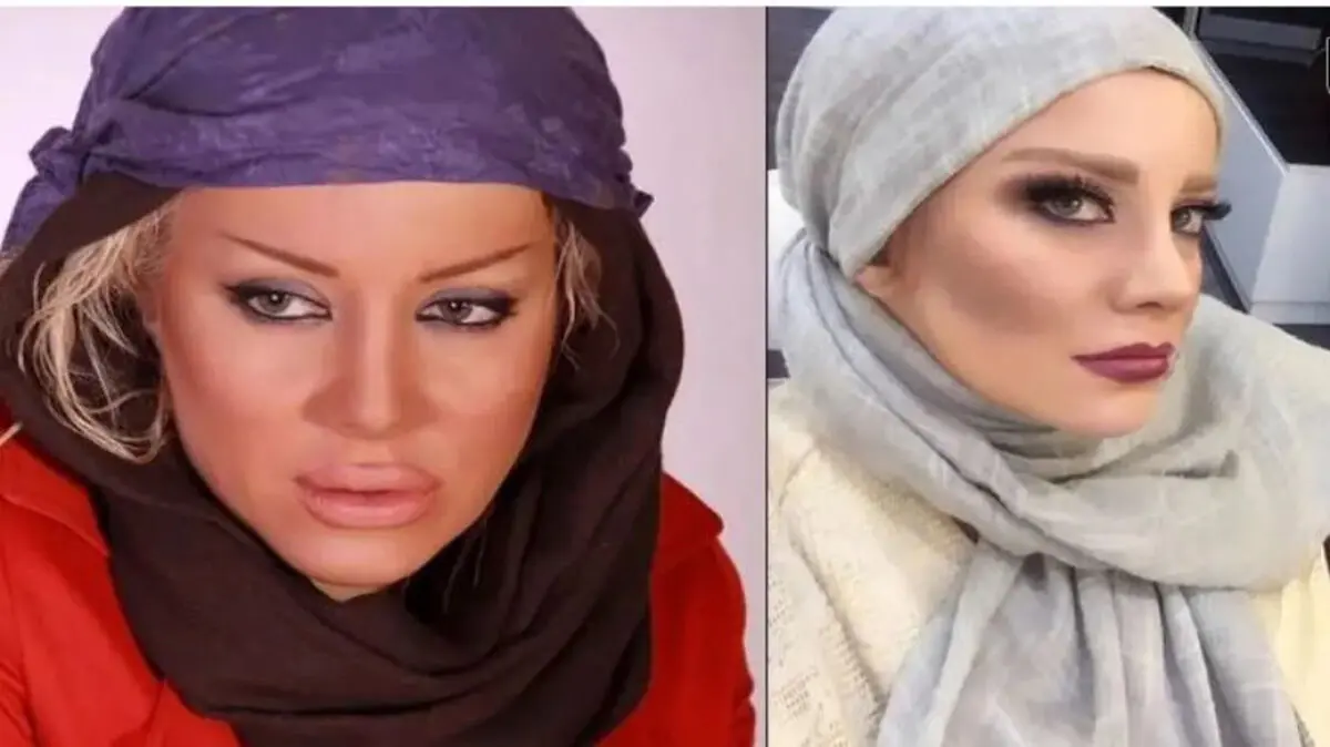 شراره رخام: تزریق ژل لب بازیگری منو نابود کرد/ ویدئو