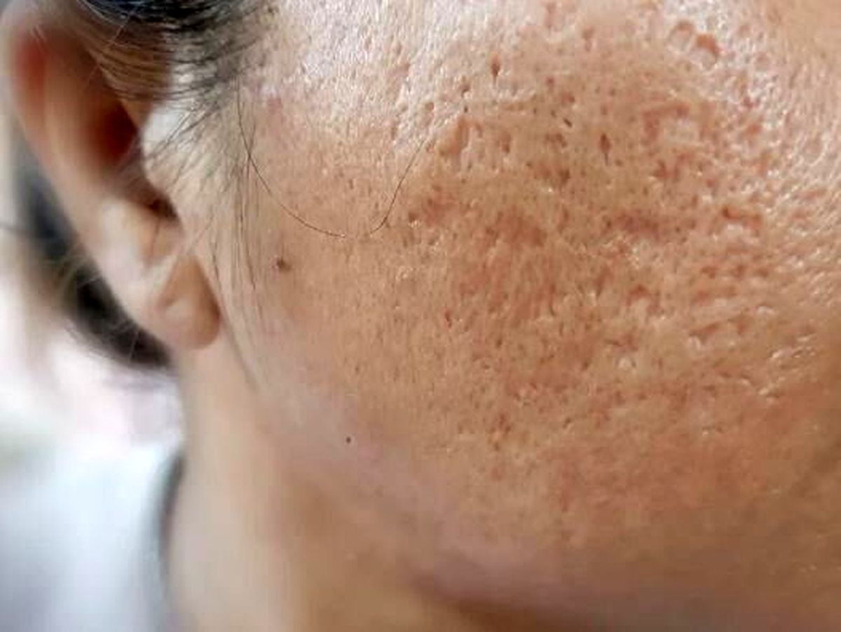 راهکارهایی برای از بین بردن جای زخم