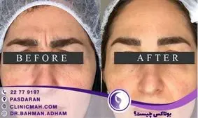 بهترین کلینیک در پاسداران برای بوتاکس