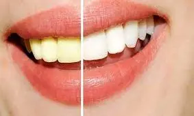 علل زرد شدن رنگ دندان ها و روش های خانگی درمان آن