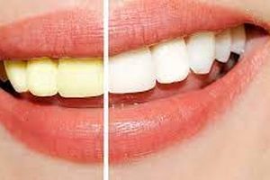 علل زرد شدن رنگ دندان ها و روش های خانگی درمان آن