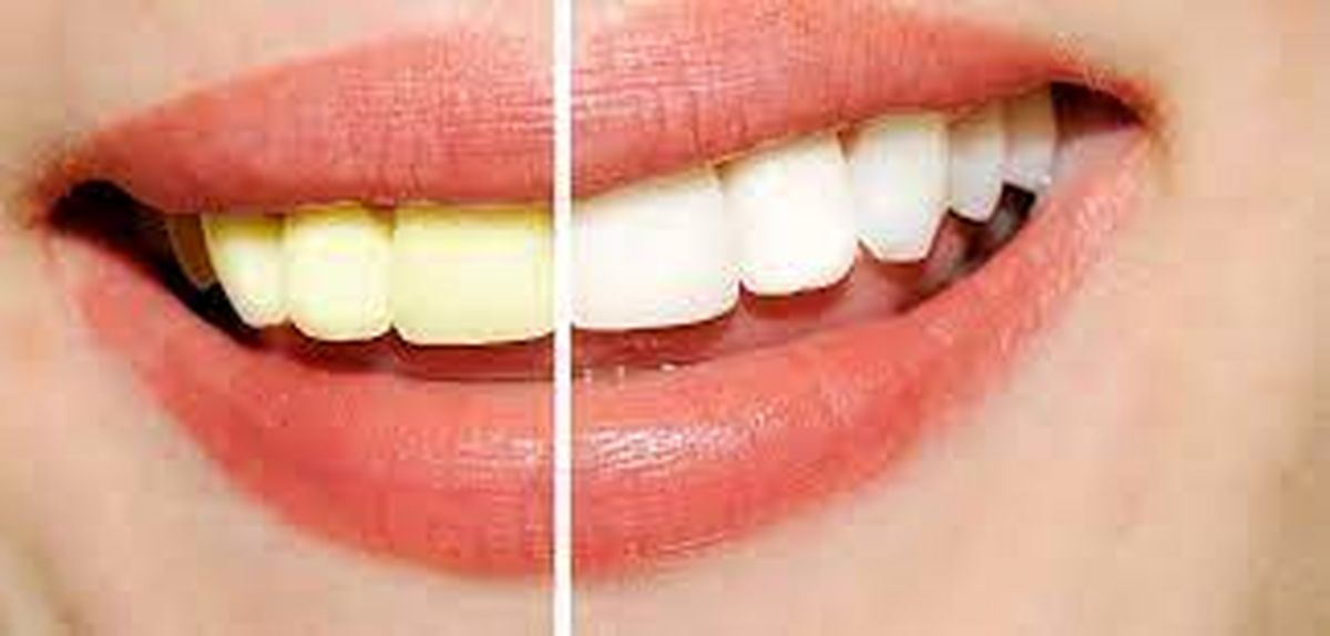 علل زرد شدن رنگ دندان ها و روش های خانگی درمان آن