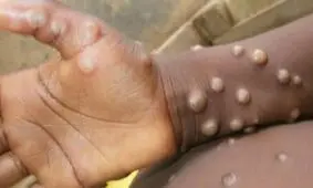 آبله میمونی به بیخ گوش ما رسید!/ ویدئو
