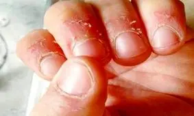 علت پوست پوست شدن اطراف ناخن و روش های درمان