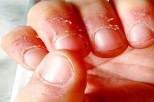 علت پوست پوست شدن اطراف ناخن و روش های درمان